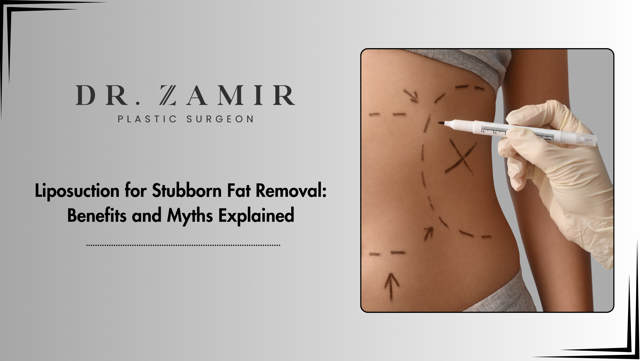 Liposuction for Stubborn Fat Removal