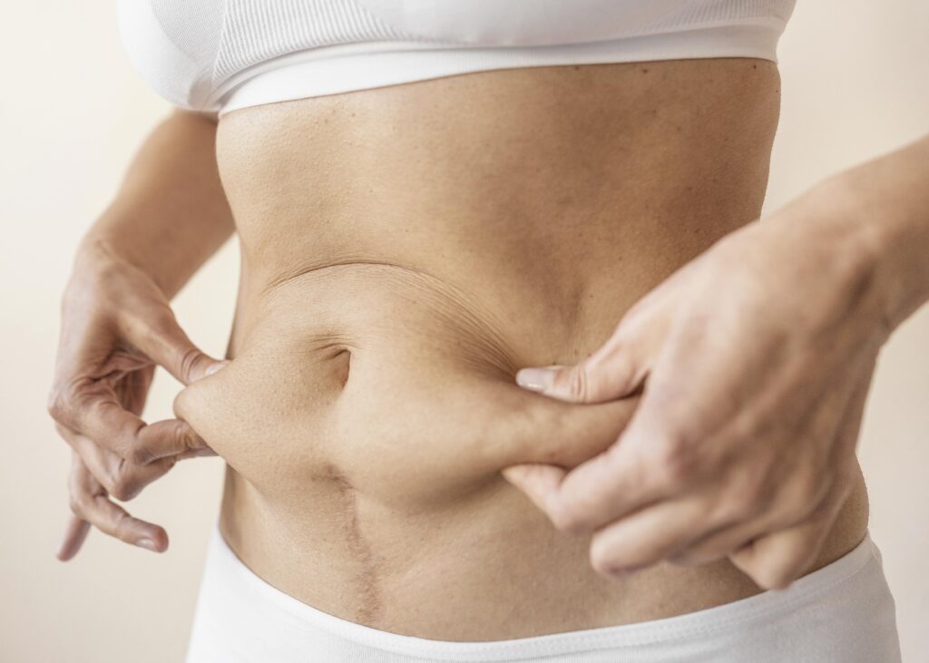 Tummy tuck