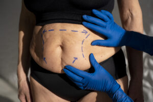 Liposuction vs tummy tuck