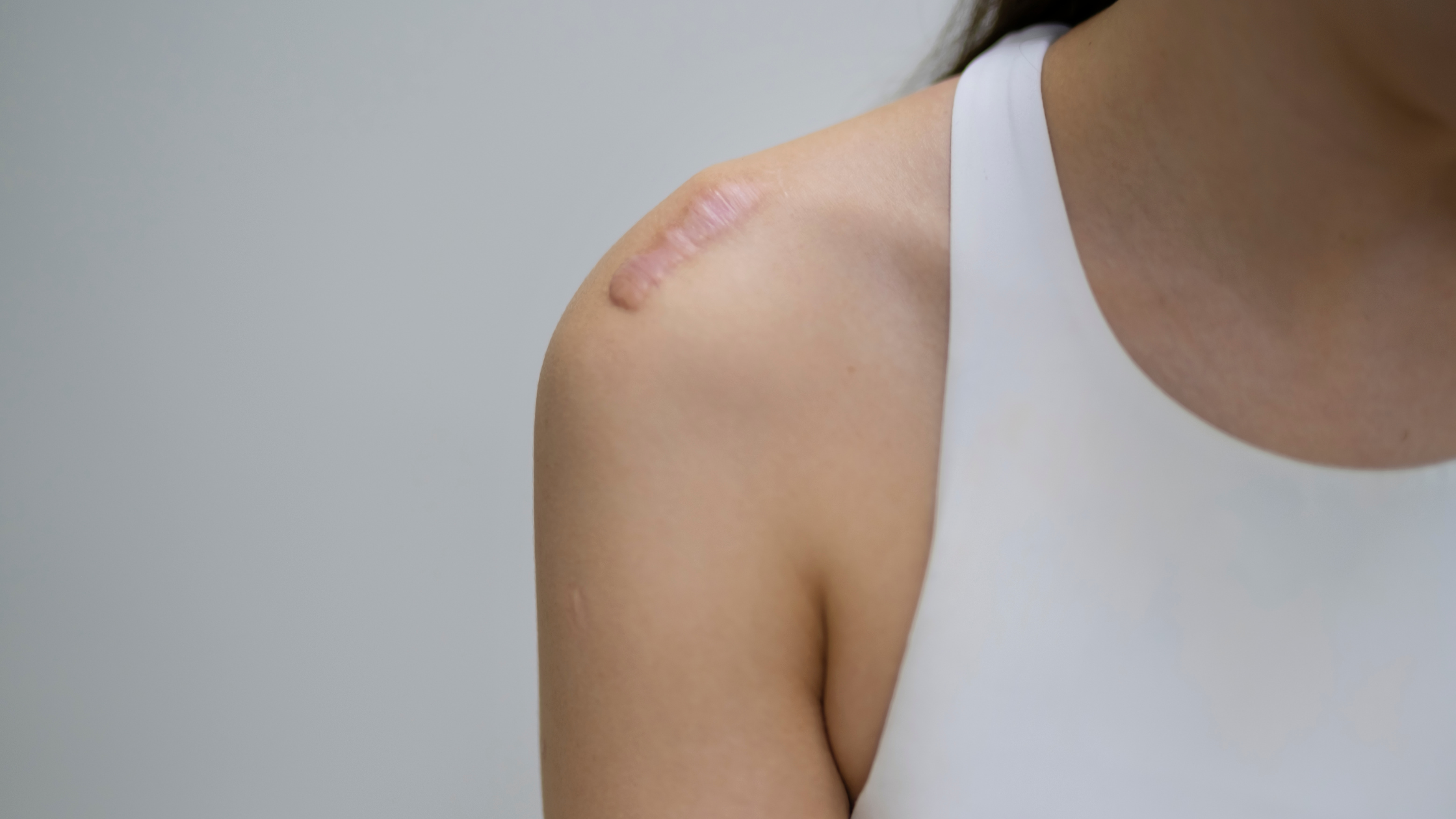 keloid and hypertrophic scars