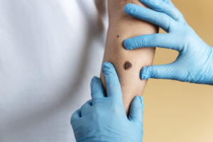 managing keloid scars